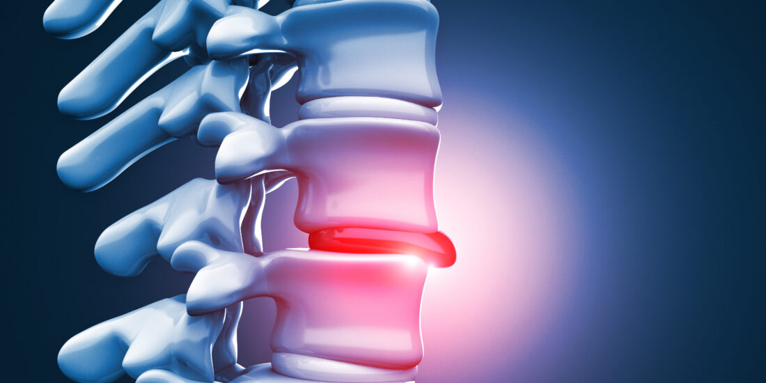 A 3-D rendering of a herniated disc in a human spine, showing a common cause of living with back pain.