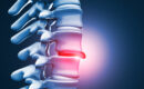 A 3-D rendering of a herniated disc in a human spine, showing a common cause of living with back pain.