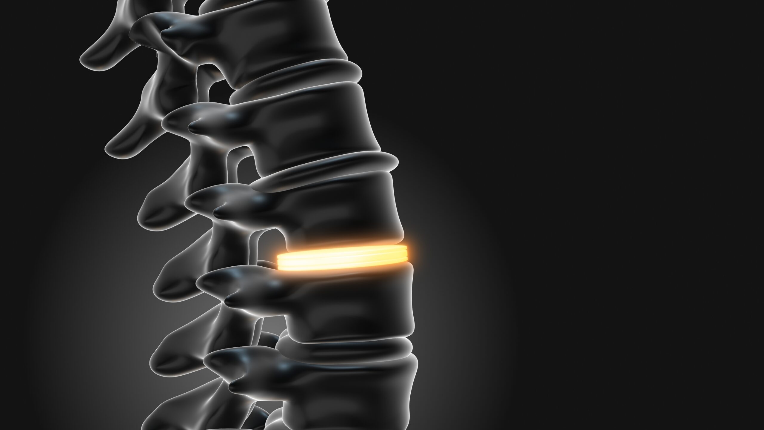 A lumbar implant illustration that shows stabilization of the spine through motion preservation surgery techniques.